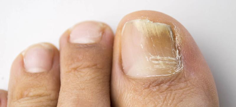 Pielęgnacja paznokci podczas grzybicy