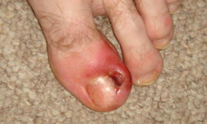 Chirurgiczne usuwanie paznokcia