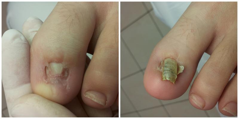 Przebieg zabiegu krok po kroku