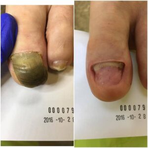 Czy chirurgiczne usuwanie paznokcia naprawdę jest bolesne? Oto, co warto wiedzieć