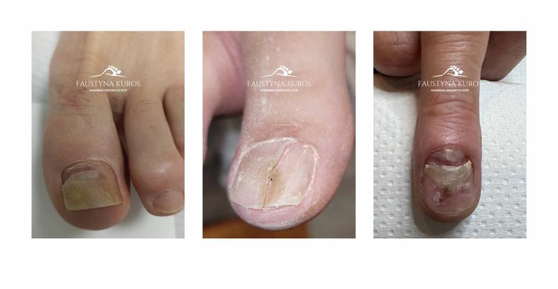 Kiedy do specjalisty od paznokci