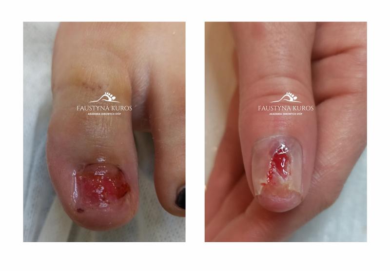 Pęknięty paznokieć regeneracja i leczenie