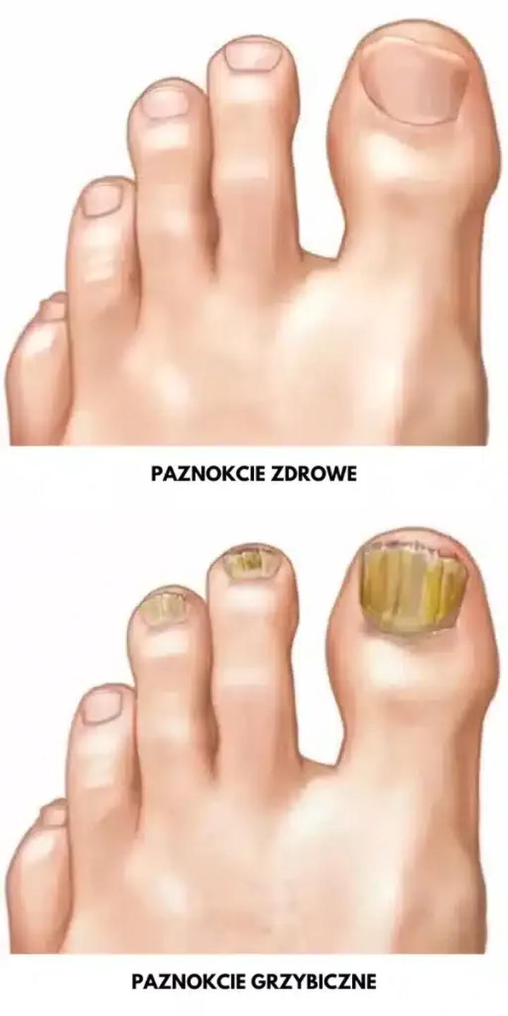 Zapobieganie nawrotom grzybicy paznokci